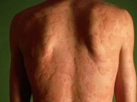 Urticaria