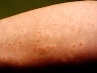 Urticaria