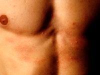 Warmte urticaria (cholinergische urticaria)