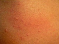 Warmte urticaria (cholinergische urticaria)