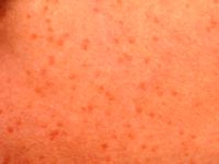 Warmte urticaria (cholinergische urticaria)