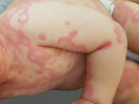 Urticaria multiforme