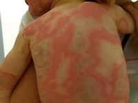 Urticaria multiforme