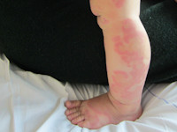 Urticaria multiforme