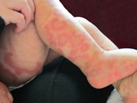 Urticaria multiforme