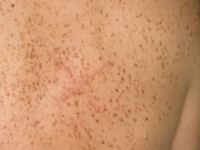 Urticaria pigmentosa