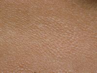 Urticaria pigmentosa