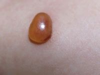 Urticaria pigmentosa