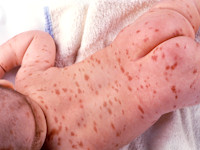 Urticaria pigmentosa