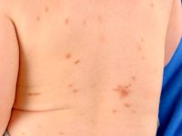 Urticaria pigmentosa