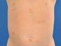 Urticaria pigmentosa