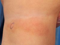 Urticaria pigmentosa