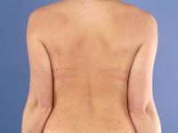 Urticaria pigmentosa