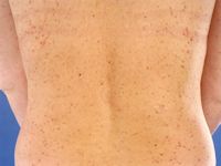 Urticaria pigmentosa