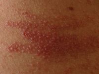 Pseudovesiculeuze variant van urticaria factitia