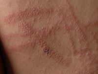 Pseudovesiculeuze variant van urticaria factitia
