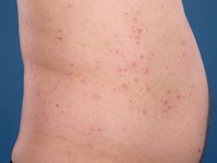 Urticariële dermatitis