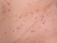 Urticariële dermatitis