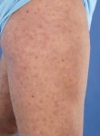 Hypocomplementaire urticariële vasculitis (HUV)