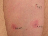 Autoloog serum test bij chronische urticaria