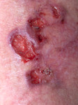 Pyoderma gangrenosum