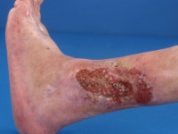 Ulcus cruris bij Felty syndroom