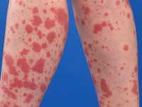 Vasculitis type Henoch Schönlein