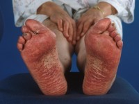 Vasculitis type Henoch Schönlein