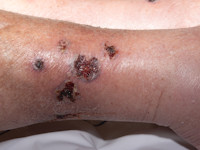 Vasculitis bij Sjögren syndroom