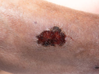 Vasculitis bij Sjögren syndroom