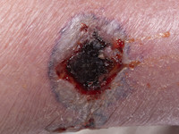 Vasculitis bij Sjögren syndroom