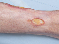 Vasculitis bij Sjögren syndroom