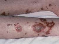 Vasculitis bij infectie (meningitis)