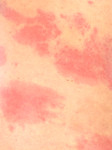 Urticaria