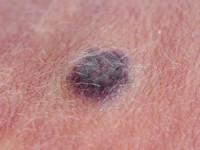 Familial cutaneo-mucosal venous malformation