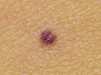 Familial cutaneo-mucosal venous malformation