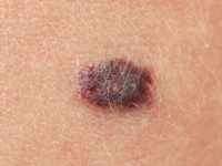 Familial cutaneo-mucosal venous malformation