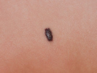 Familial cutaneo-mucosal venous malformation