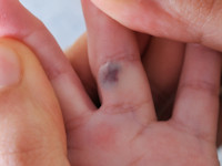 Familial cutaneo-mucosal venous malformation