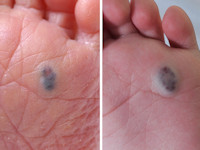 Familial cutaneo-mucosal venous malformation