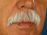 venous lake (vasodilation on the lip)