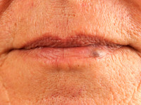 venous lake (vasodilation on the lip)