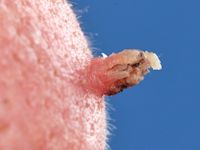 Filamentous wart, verruca filliformis