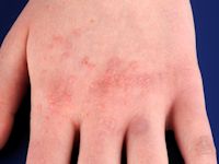 Flat wart, verruca plana