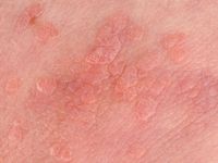 Flat wart, verruca plana