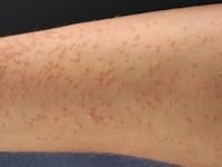 Vlakke wrat, verruca plana