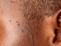 Flat wart, verruca plana