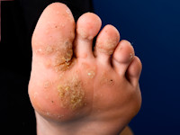 Plantar warts, verruca plantaris