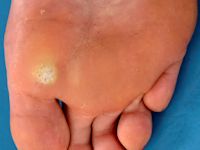 Plantar warts, verruca plantaris