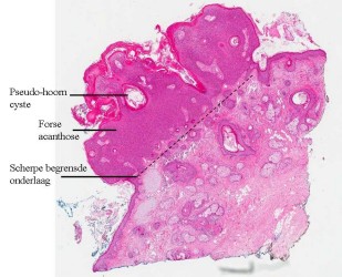 PA verruca seborroica